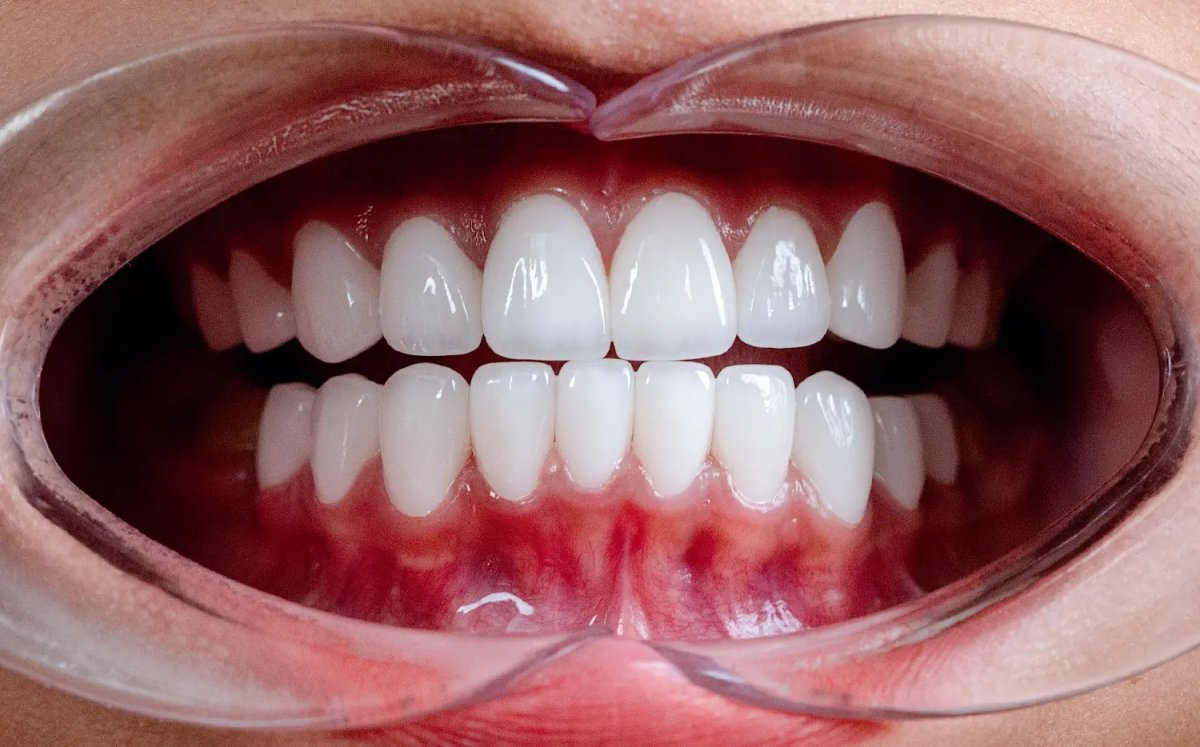 Dental crown installation result – improved smile aesthetics and restored tooth function