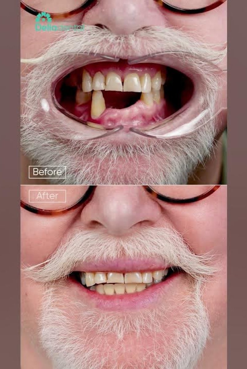 Before and after All-on-4 dental implants result, restored smile and teeth at Dentaesthetic clinic