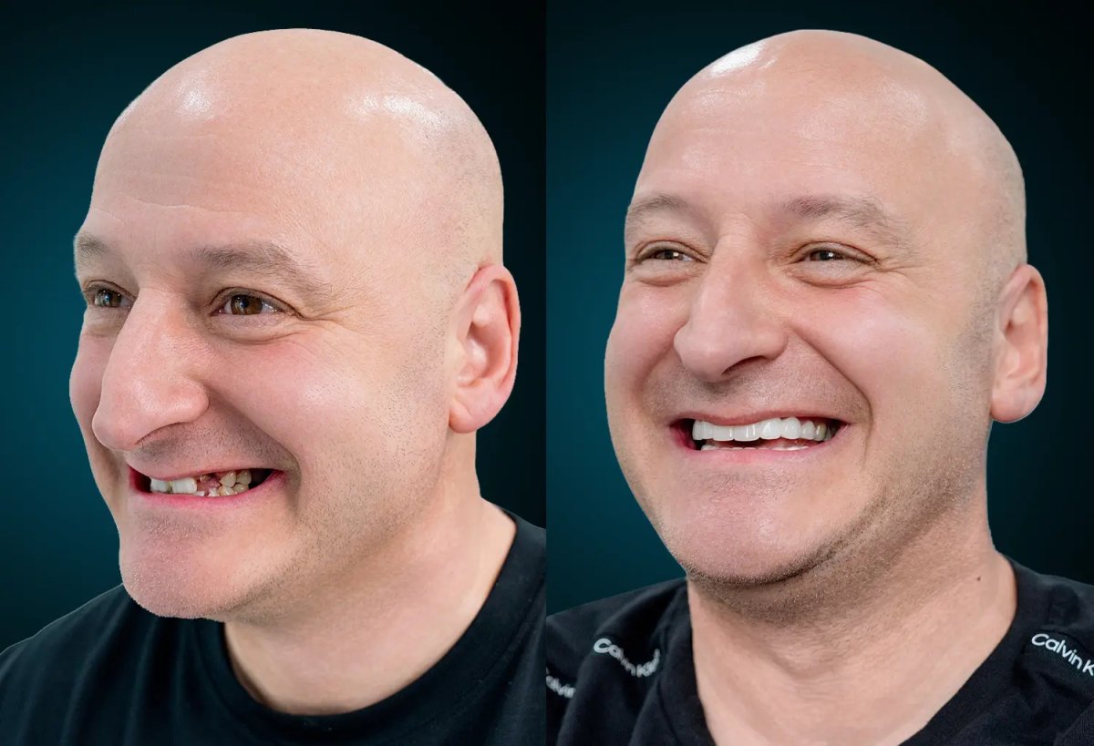 Smile makeover before and after result – improved teeth alignment and whiter smile