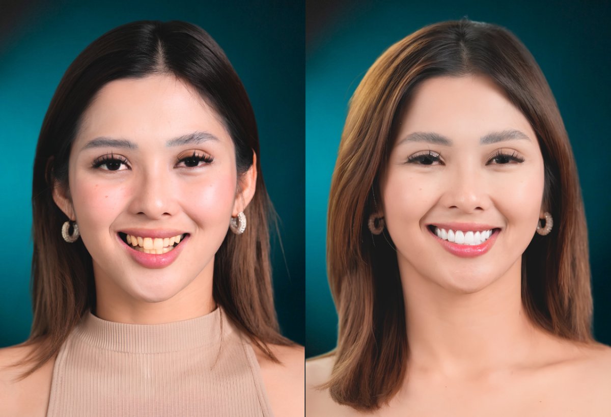 Résultats avant/après smile makeover – facettes dentaires pour dents alignées et blanches