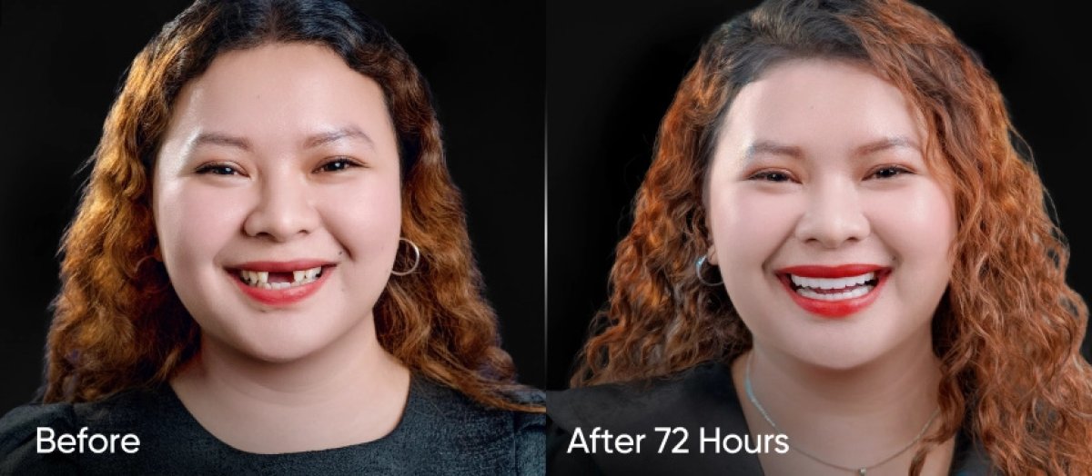 Smile makeover before and after results – improved teeth alignment and whiter smile in 72 hours
