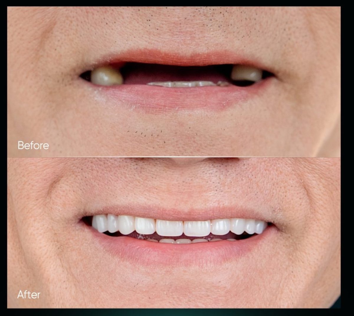 Before and after dental implant results – restored smile with natural-looking teeth