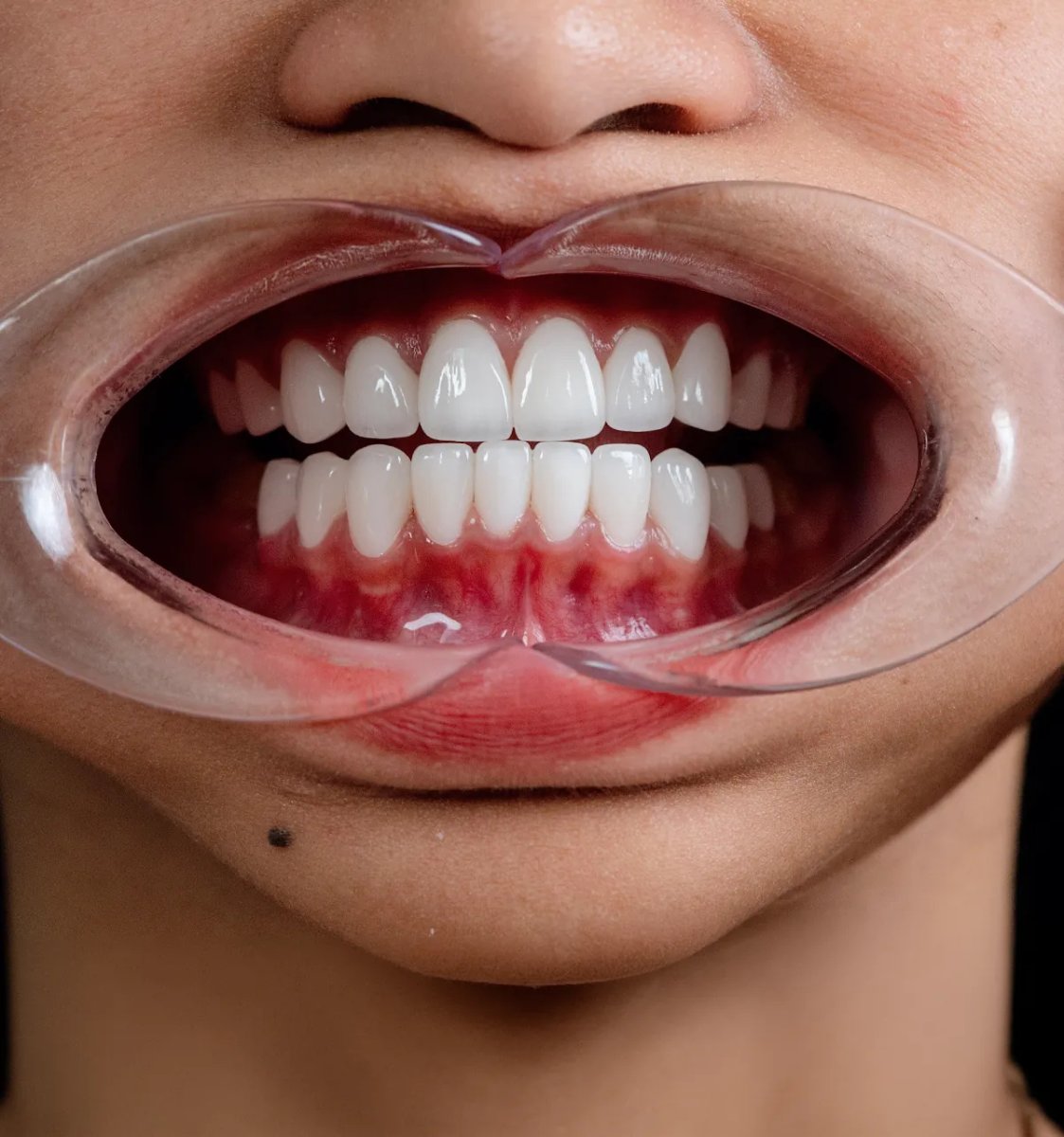 Resultado de carillas de porcelana mostrando dientes blancos y alineados tras el tratamiento