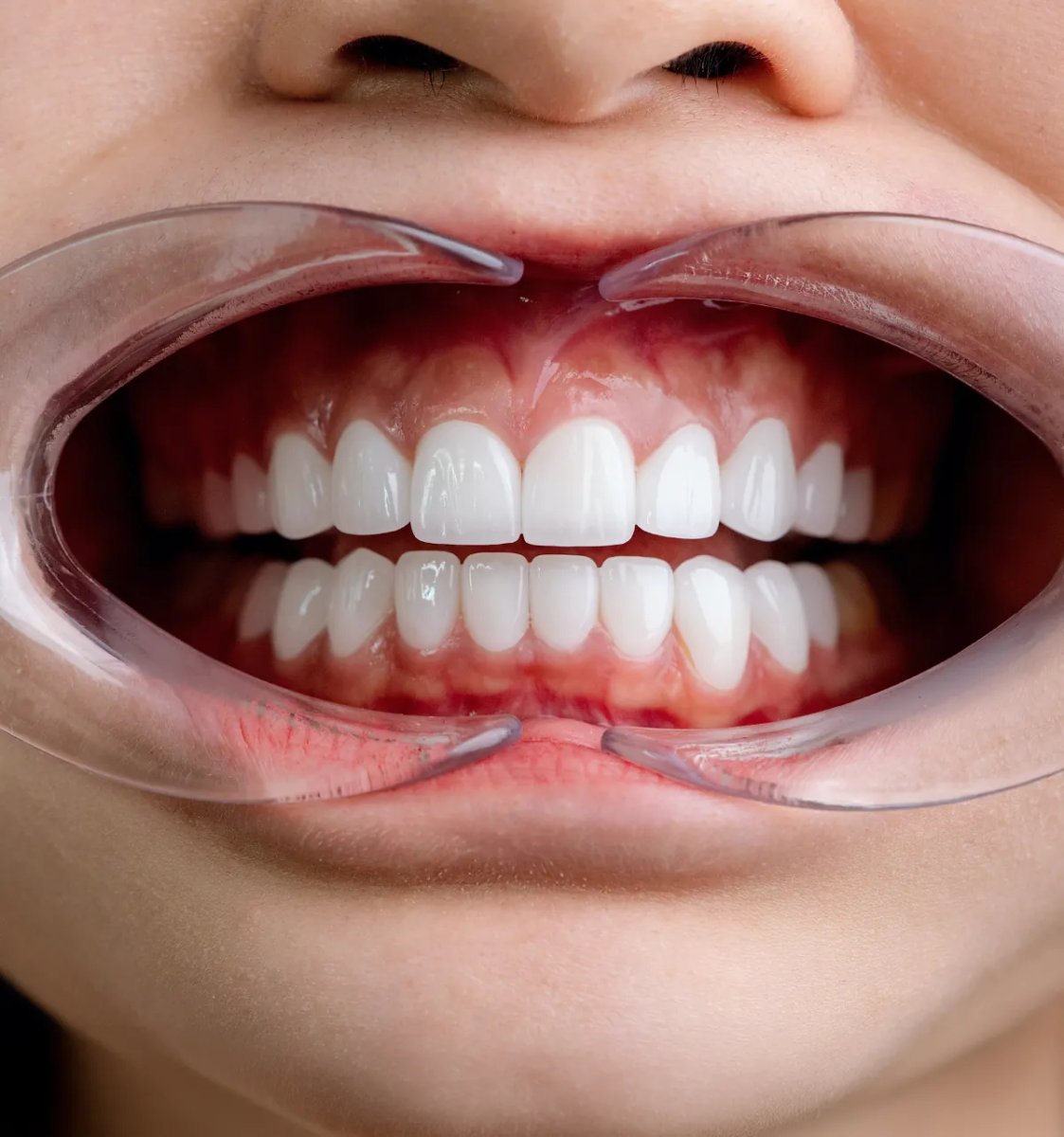 Résultat de facettes en porcelaine montrant des dents blanches et alignées après traitement