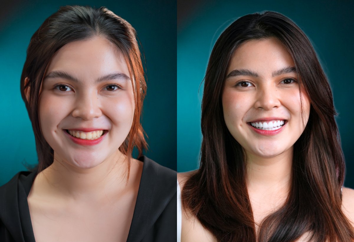 Resultados antes y después de coronas de zirconia: sonrisa mejorada y dientes más blancos