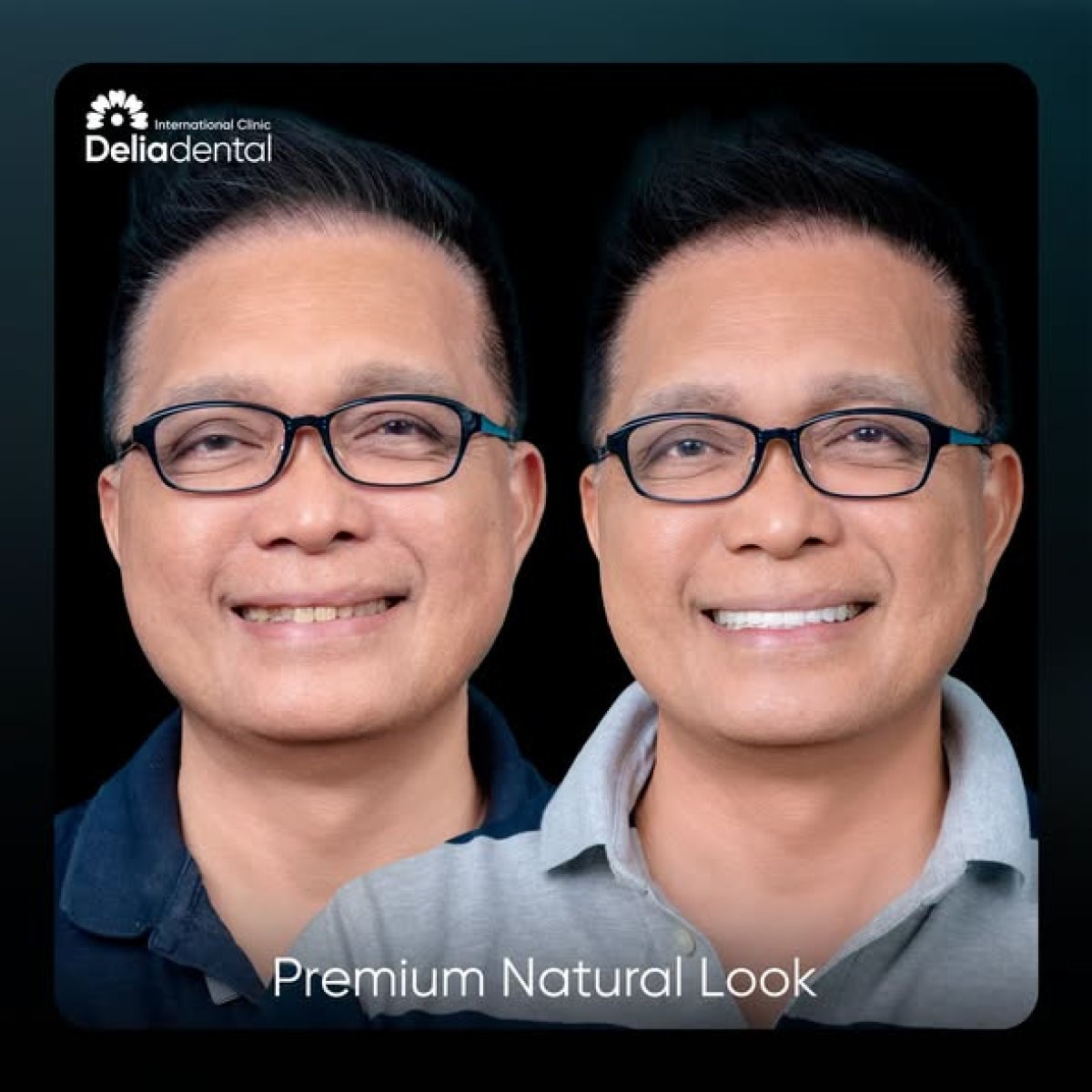نتائج قبل وبعد تركيب تيجان الزركونيا في Delia Dental – ابتسامة طبيعية