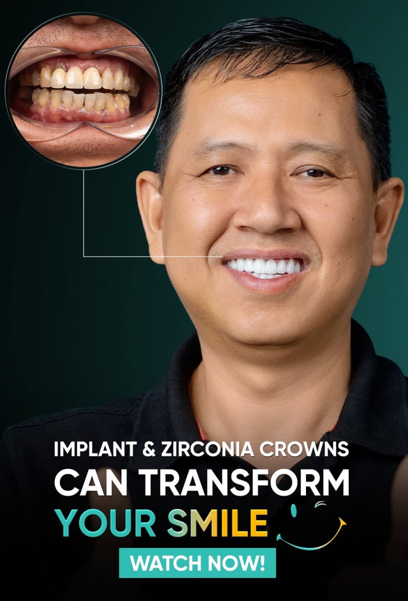 Before and after zirconia crown and implant results – smile transformation in male patient