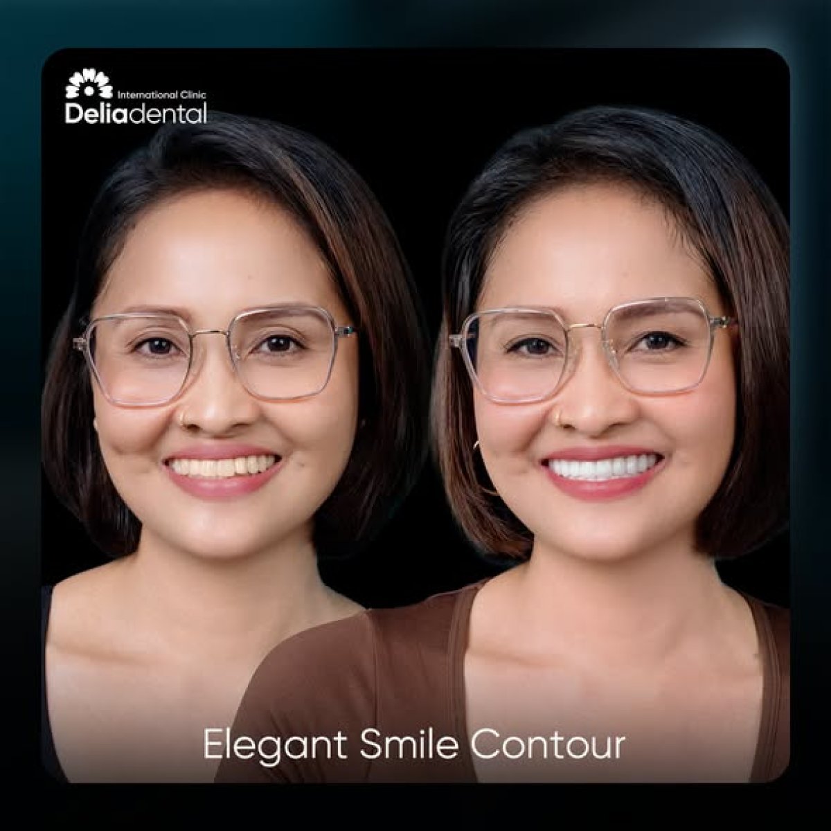 Before and after zirconia crown results at Deliadental – enhanced smile aesthetics