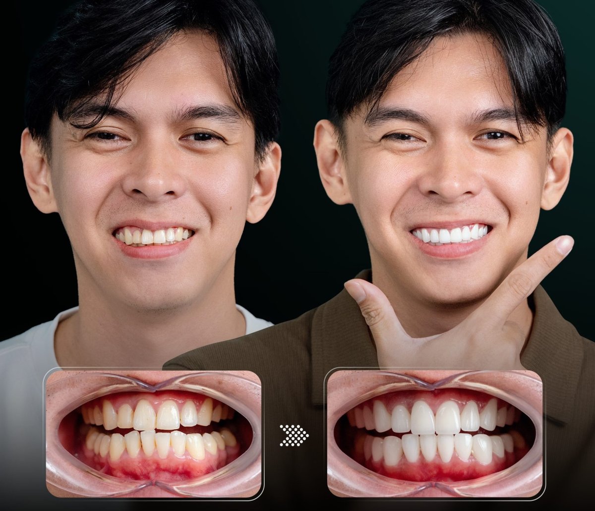 Before and after veneers results – smile transformation with whiter, even teeth