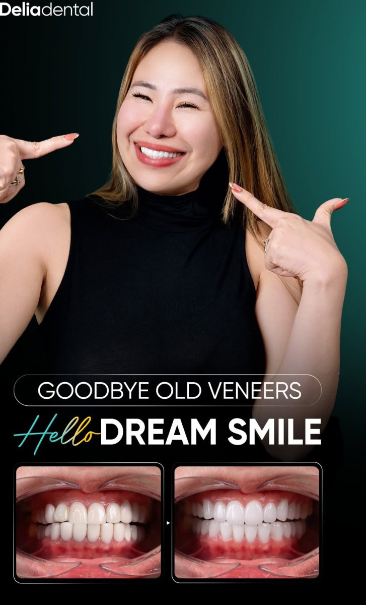 Before and after dental veneers at Delia Dental – smile makeover with natural-looking results