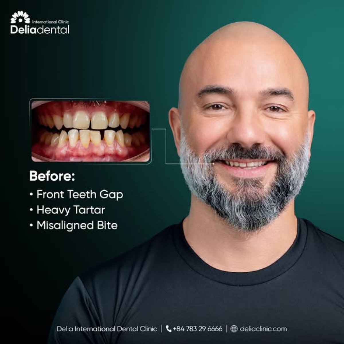 Teeth cleaning result at Delia Dental Clinic – improved smile, tartar removal, aligned teeth