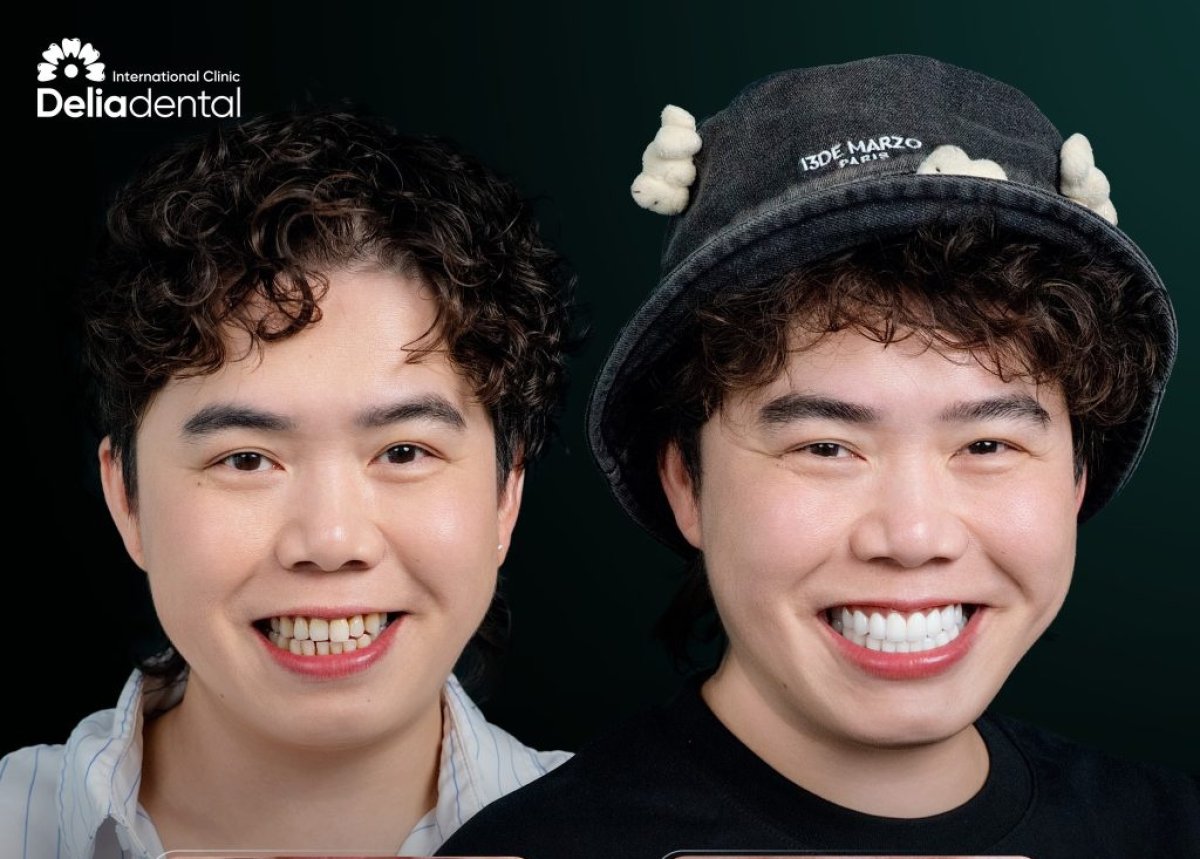 نتائج تبييض الأسنان قبل وبعد في عيادة Deliadental – ابتسامة أكثر إشراقًا