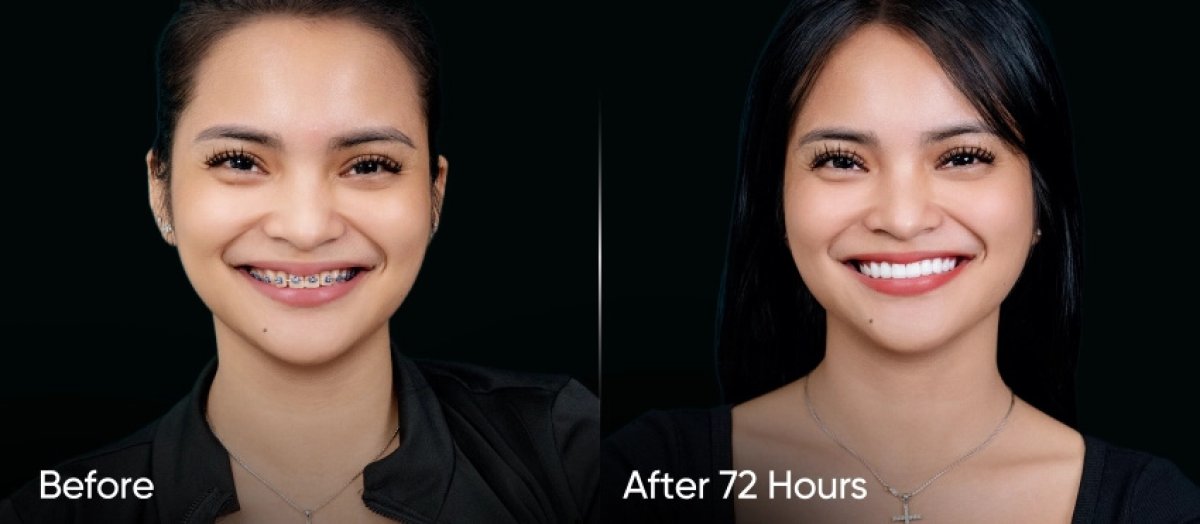 Before and after braces removal result – straight teeth and improved smile in 72 hours