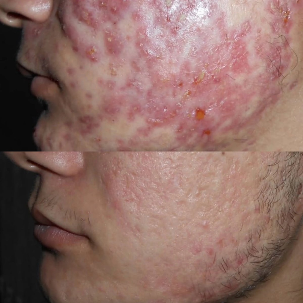 Before and after acne scar treatment results at ARS Clinic – improved skin texture