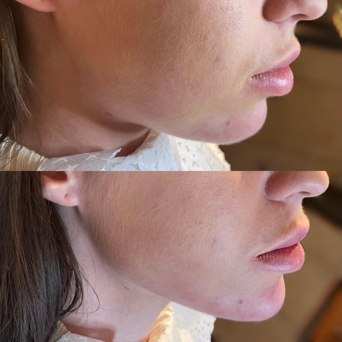 Before and after jaw shaping at ARS Clinic, improved chin contour and facial profile result