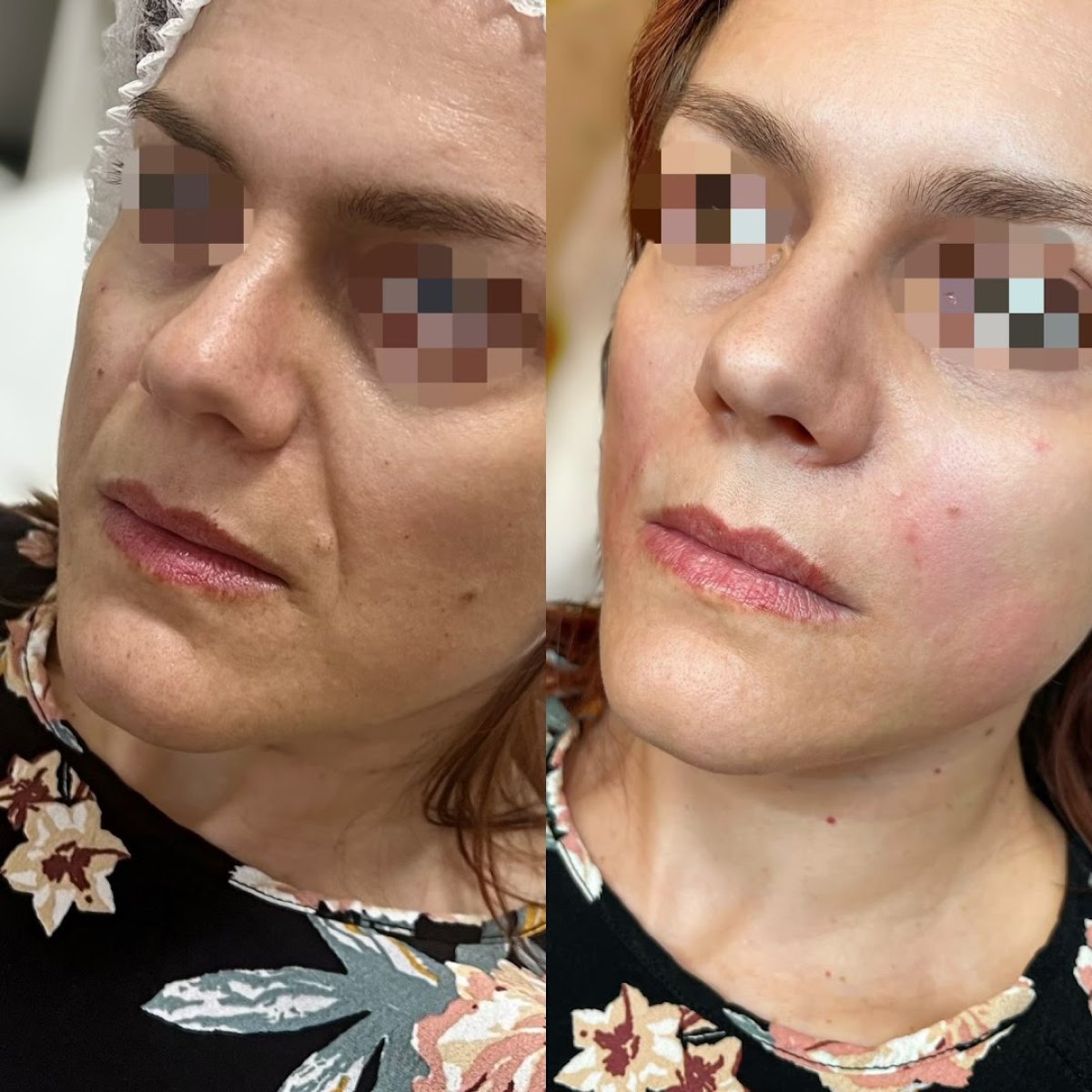 Before and after nonsurgical facelift results at ARS Clinic – smoother, rejuvenated facial skin