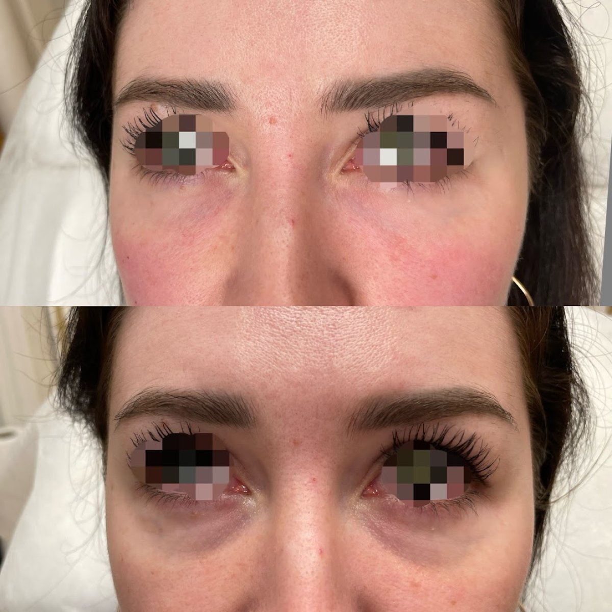 Before and after anti-wrinkle injectables at ARS Clinic, smoother under-eye area result