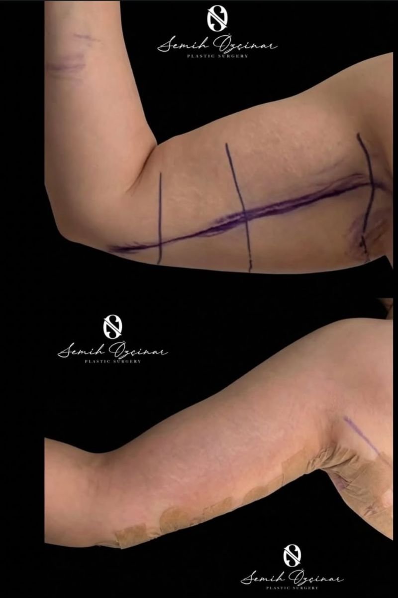 Resultados de lifting de brazos antes y después en Turan Turan Health Group, contorno mejorado