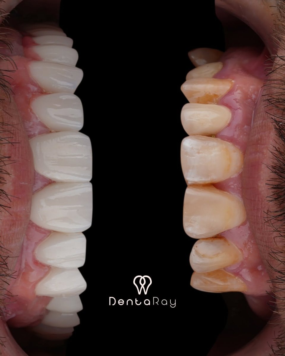 Before and after Hollywood Smile veneers at DentaRay Clinic, visible smile transformation result