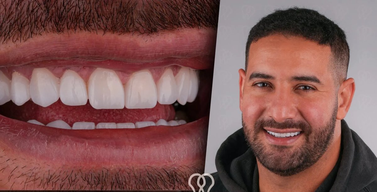 Metamorfoza uśmiechu licówkami w DentaRay Clinic, naturalny efekt