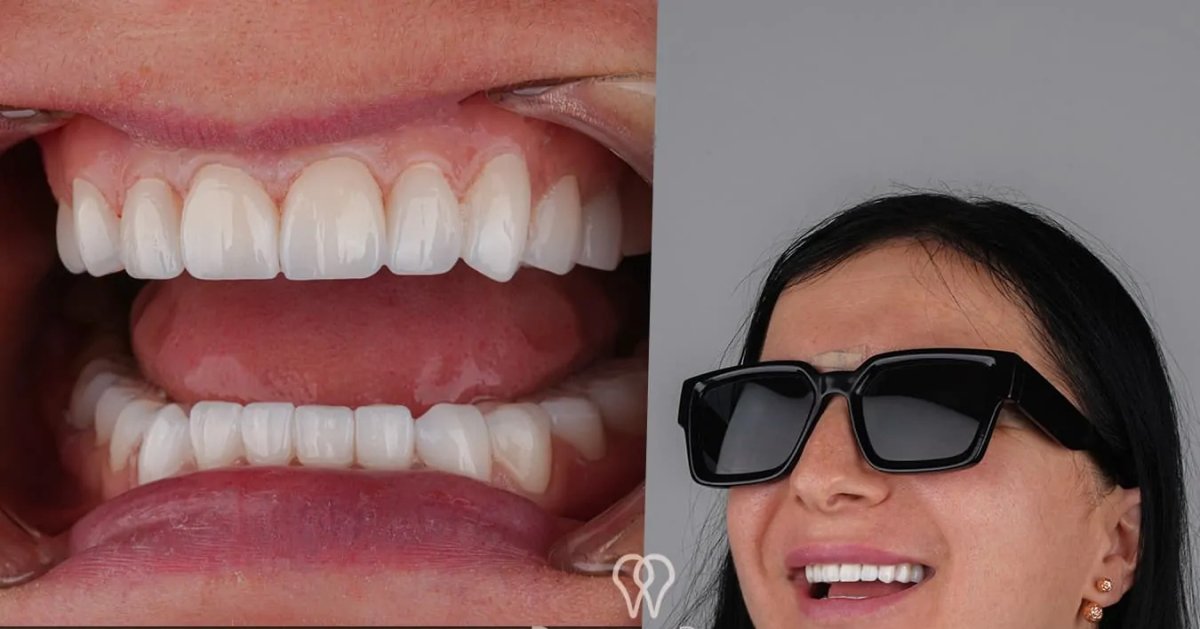 Efekt licówek w DentaRay Clinic – naturalna, biała metamorfoza uśmiechu