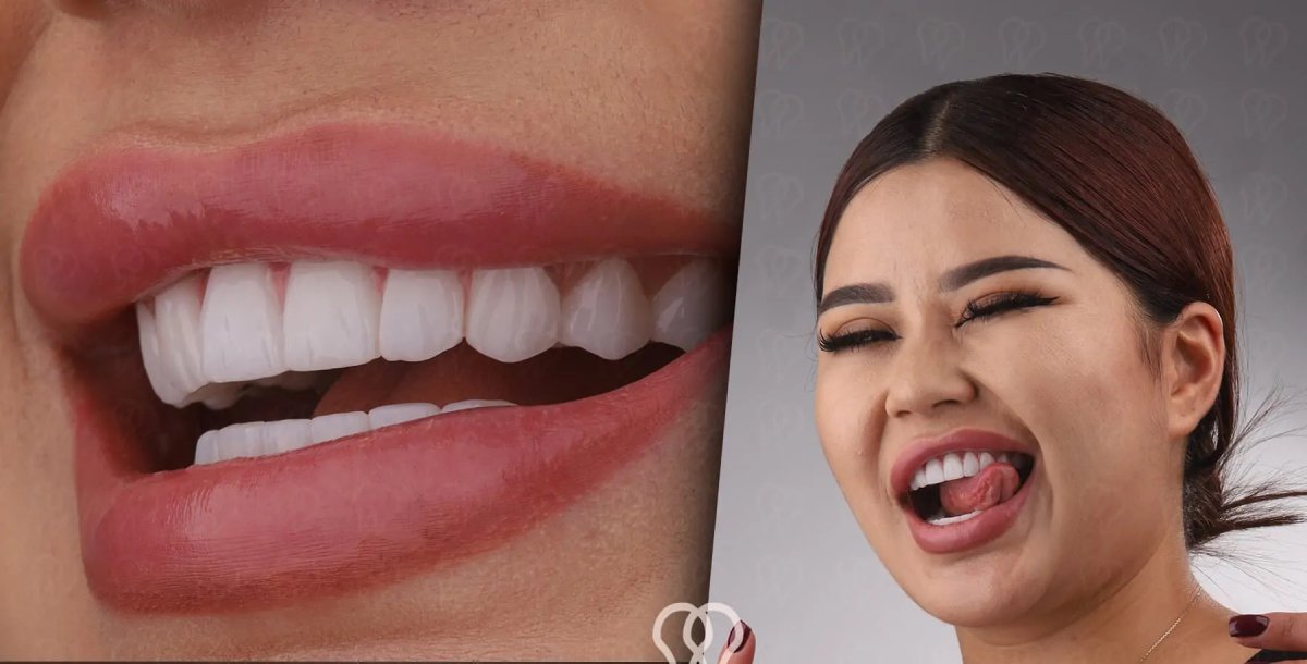 Metamorfoza uśmiechu licówkami w DentaRay Clinic, naturalnie białe zęby