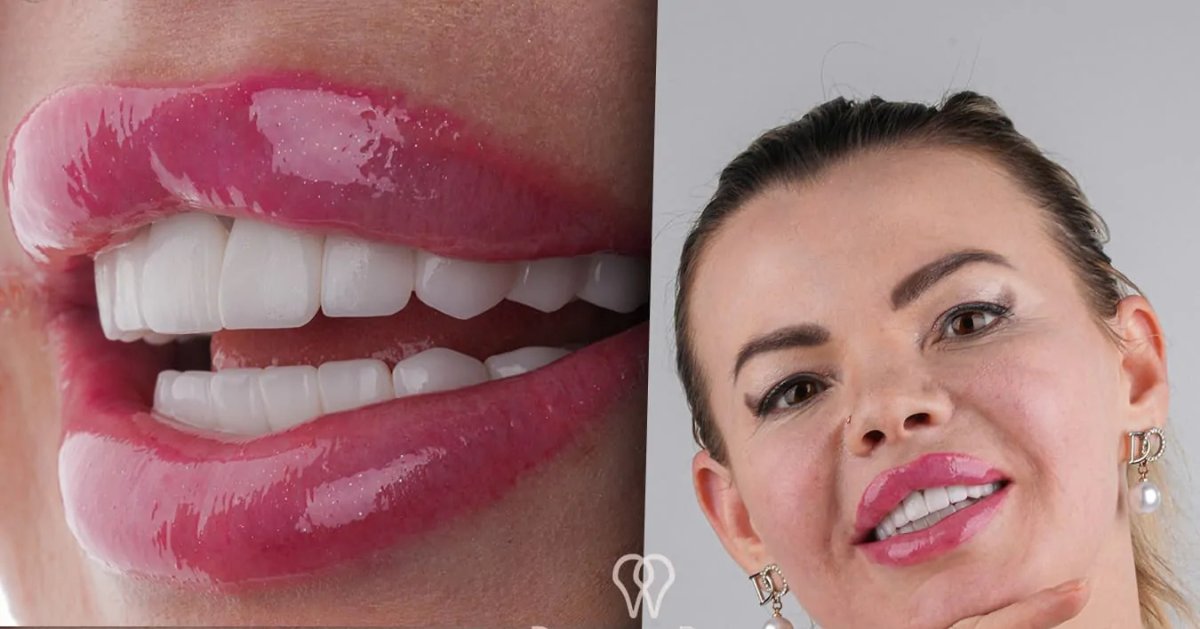 Veneers smile makeover result at DentaRay Clinic – close-up and full-face transformation