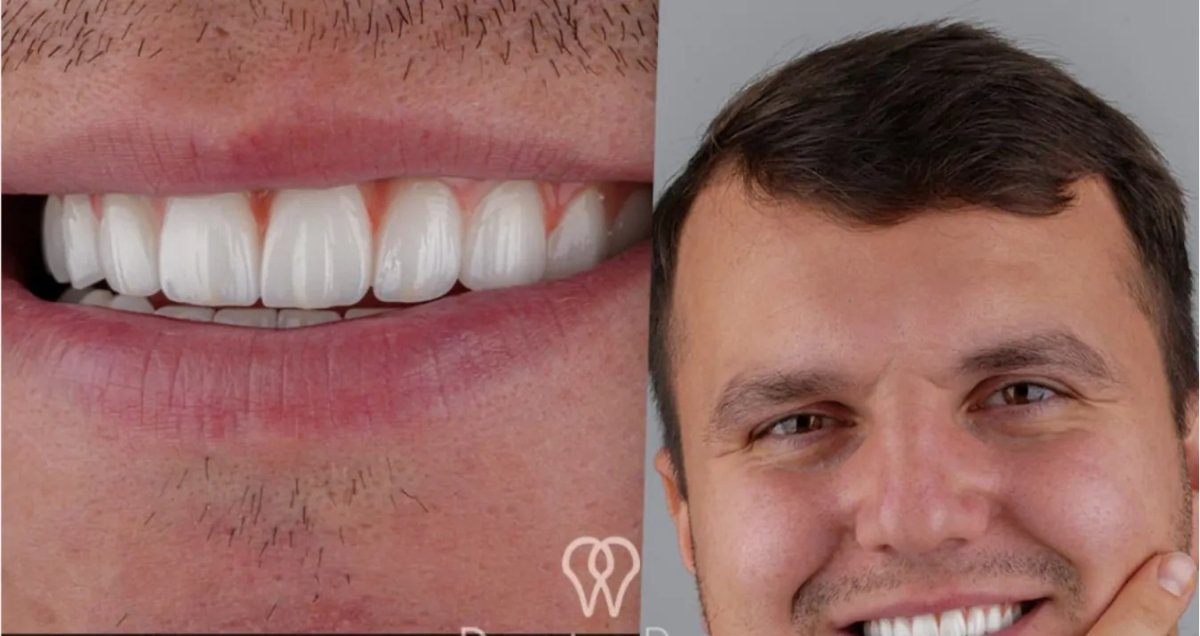 Efekt licówek porcelanowych w DentaRay Clinic – naturalna, biała metamorfoza uśmiechu