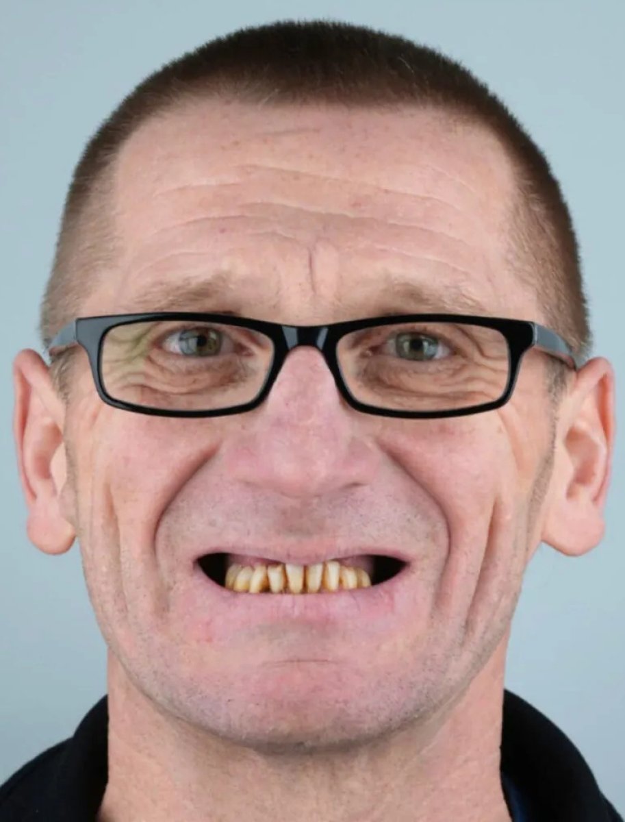 Before tooth restoration at DentaRay Clinic, visible damaged and discolored teeth result