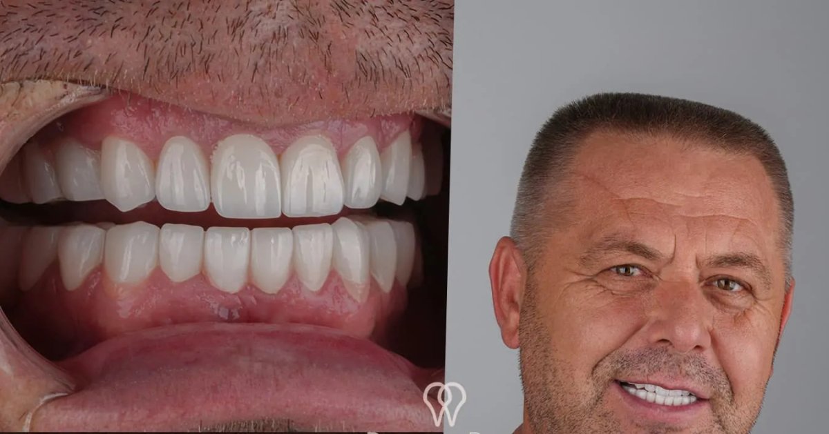 Dental implant results at DentaRay Clinic – improved smile and natural-looking teeth restoration