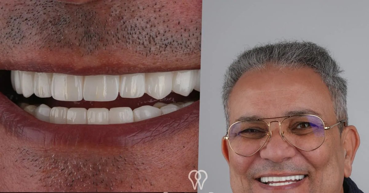 Dental implant results at DentaRay Clinic – improved smile and natural-looking teeth