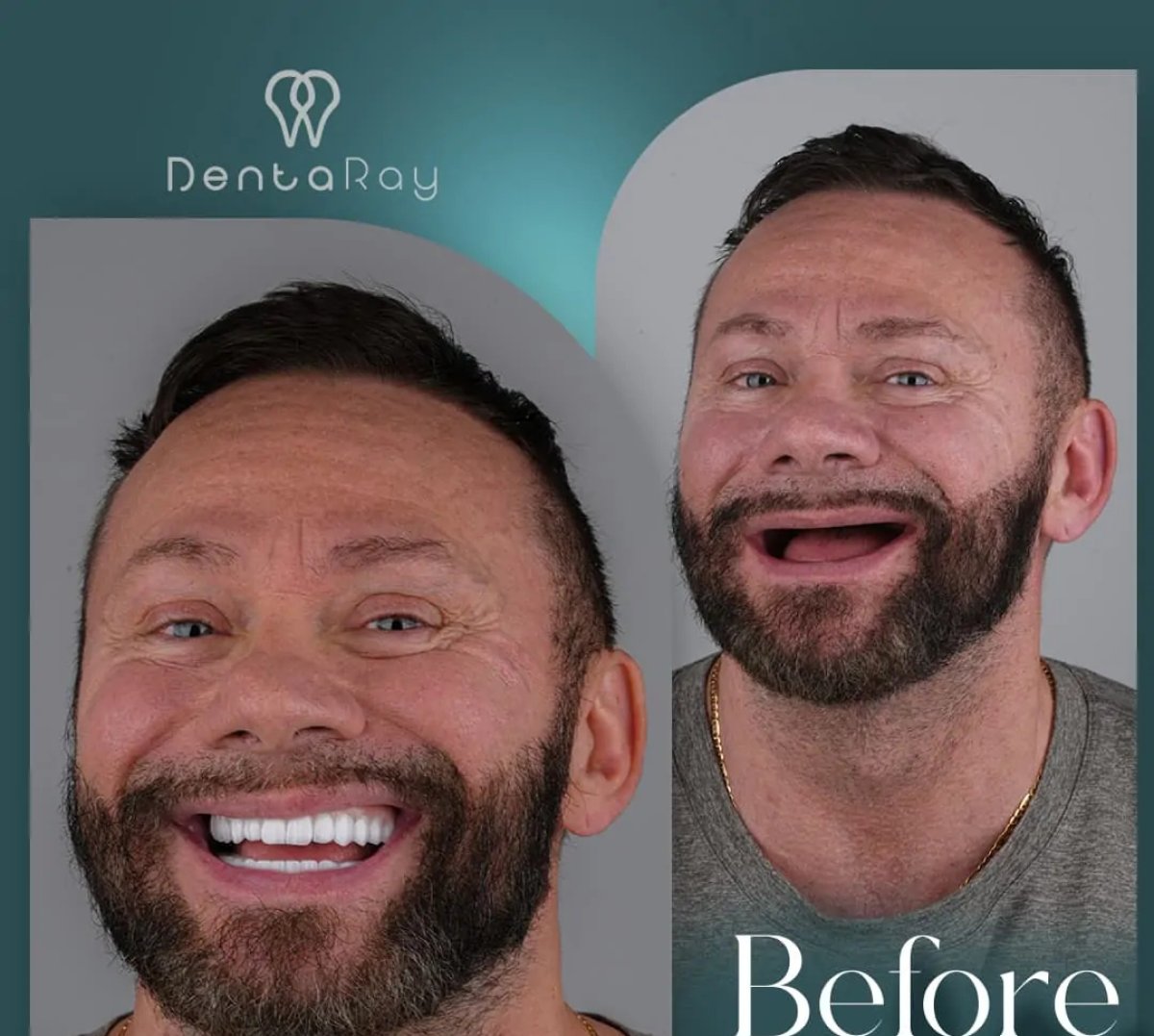 Before and after dental implant results at DentaRay Clinic – restored smile transformation