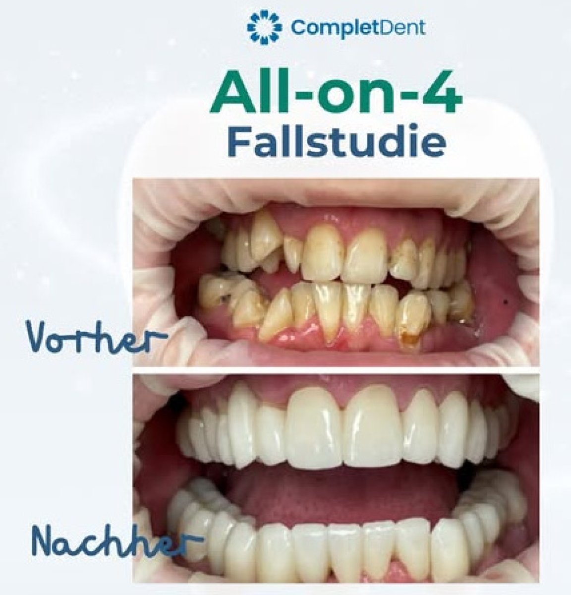 Результат до і після імплантації All-on-4 у Completdent Clinic, повне відновлення посмішки
