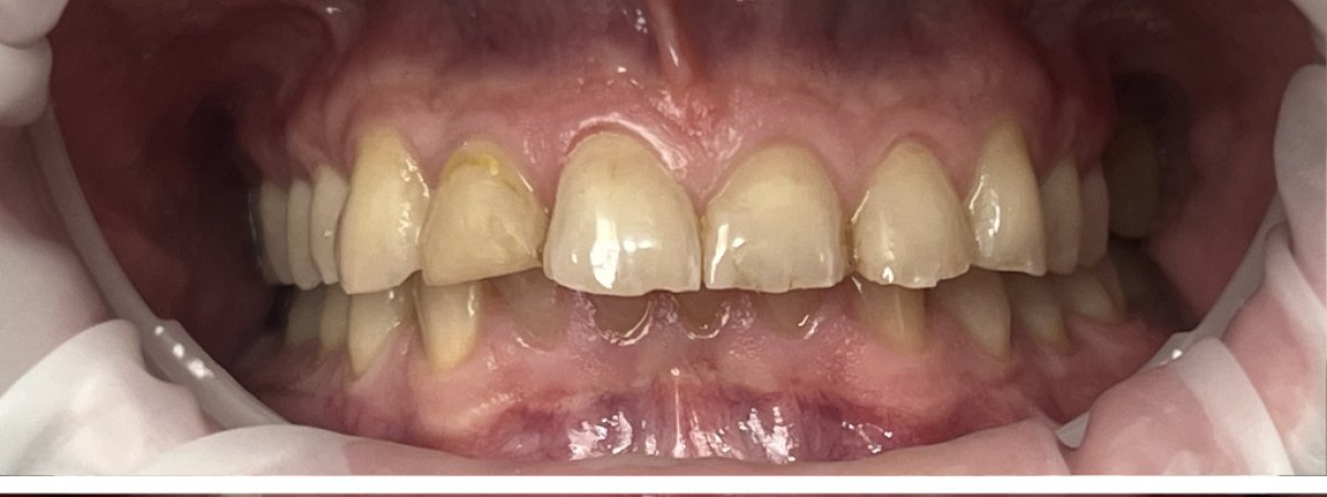 Before dental bridge installation at Completdent Clinic – visible tooth gaps and discoloration