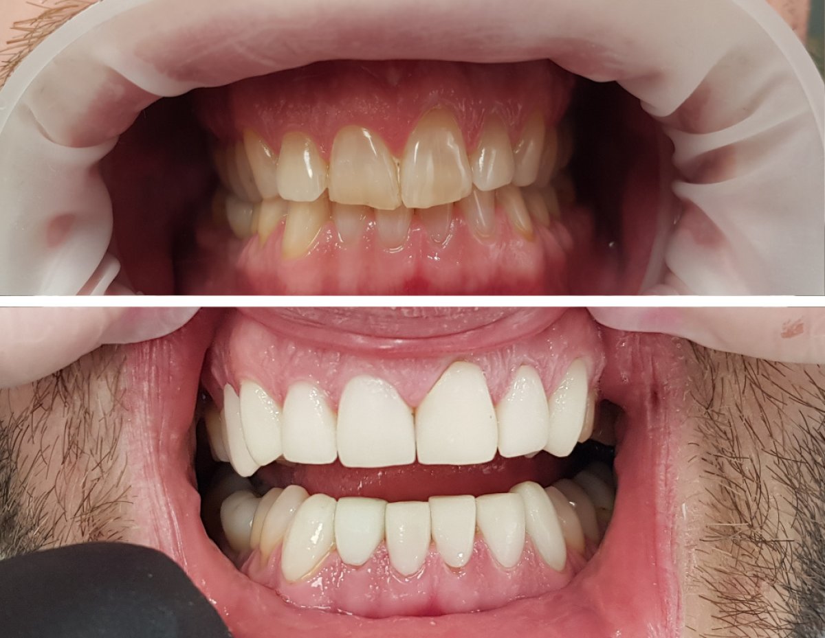 Before and after porcelain veneer results at Completdent Clinic – improved smile aesthetics