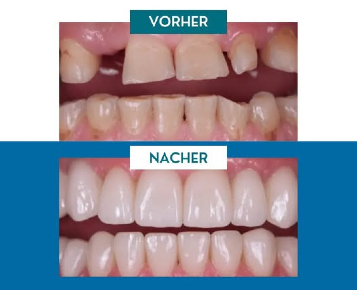 Résultat avant/après implants All-on-4 à Completdent Clinic, sourire restauré