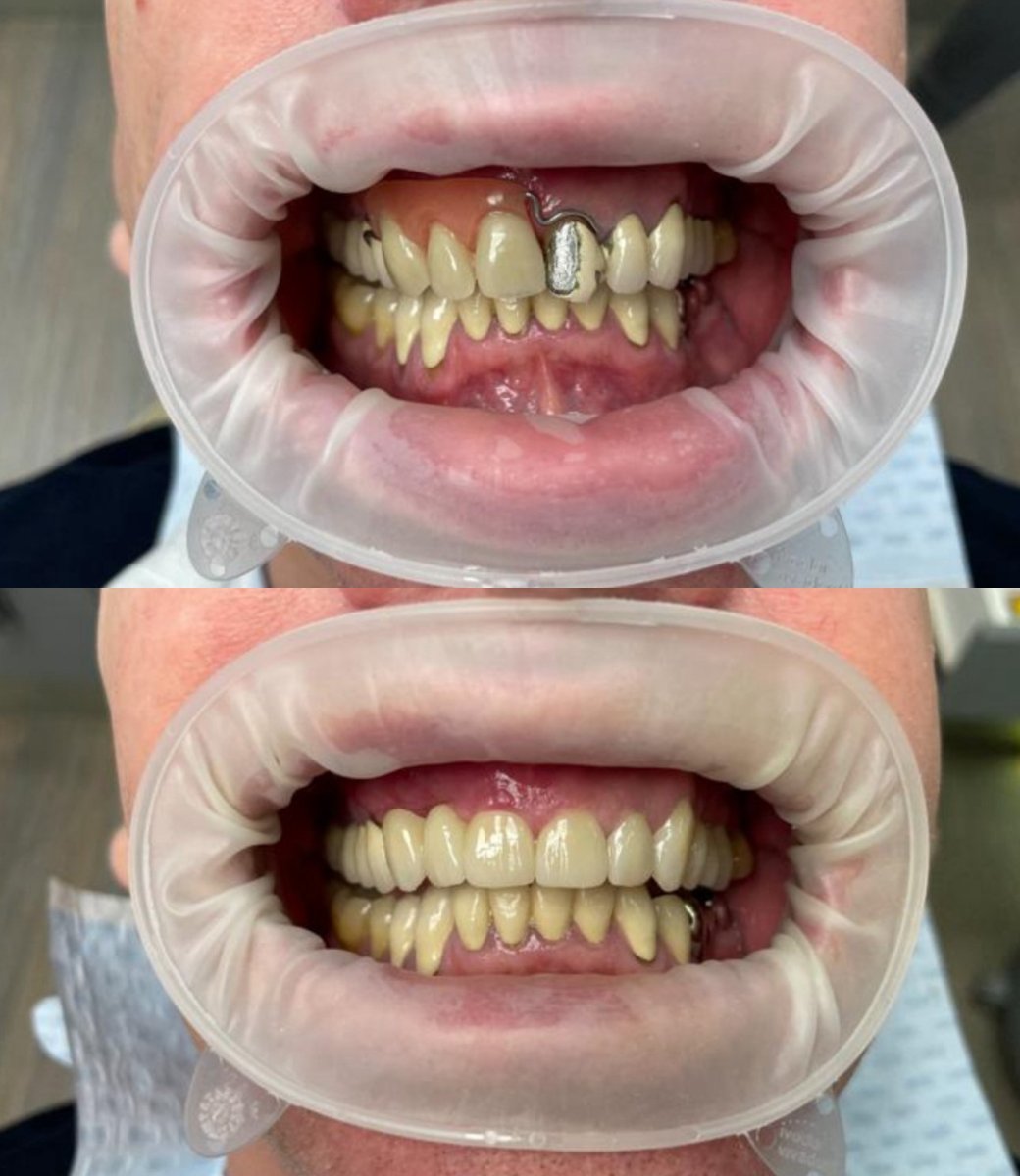 Before and after implant bridge results at Completdent Clinic – improved smile and teeth alignment