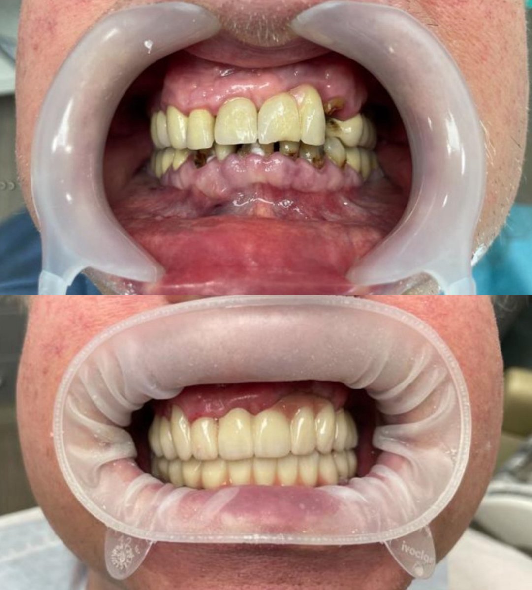 Before and after implant bridge results at Completdent Clinic – restored smile and teeth