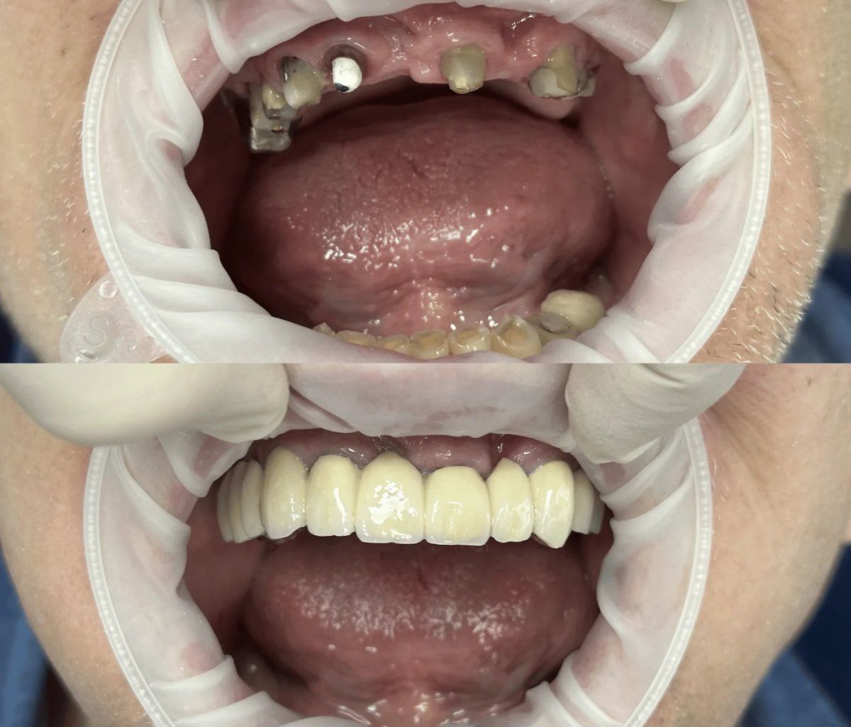 Before and after dental prosthetics installation results at Completdent Clinic, improved smile