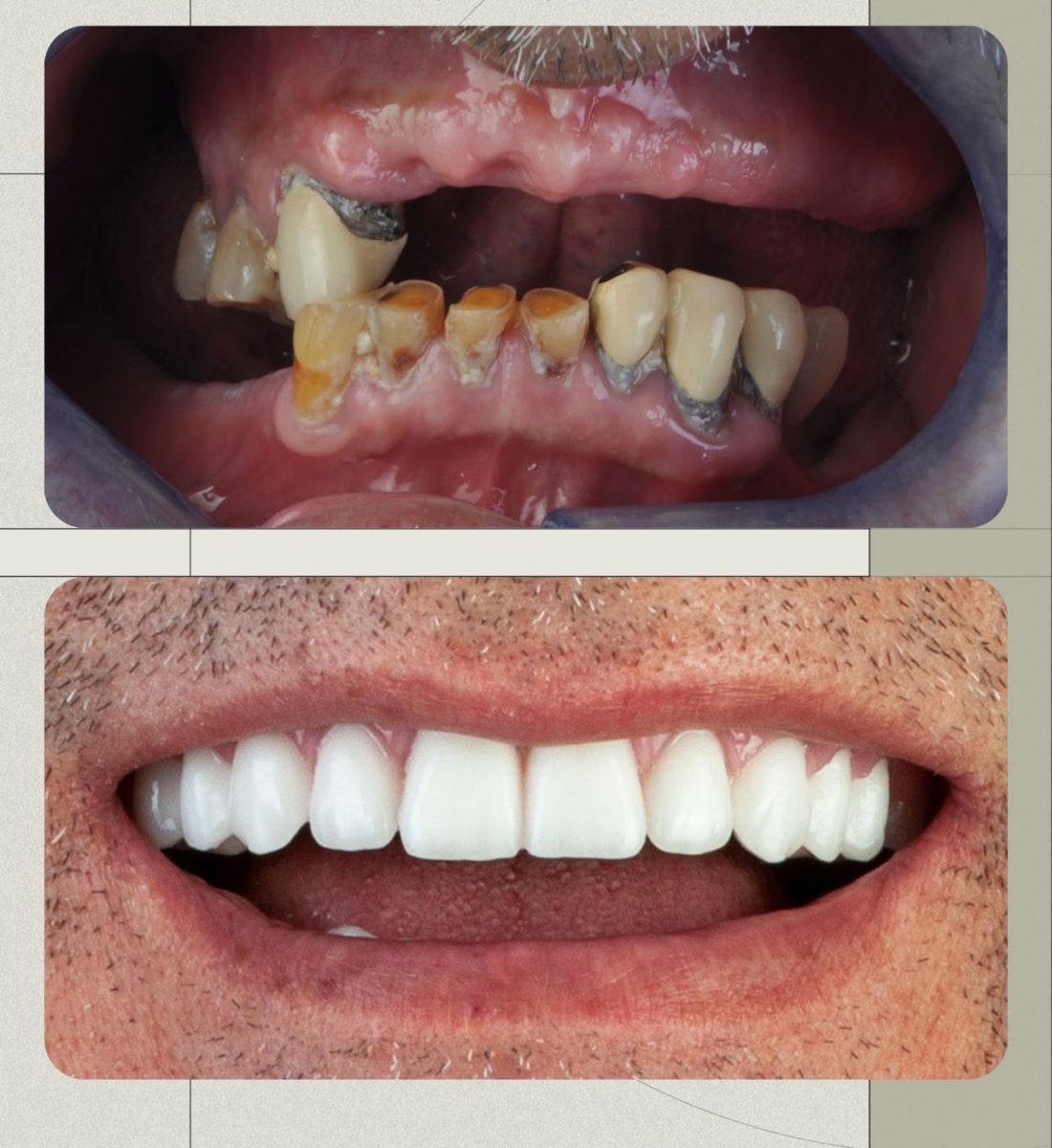 Before and after All-on-6 dental implants result at Dera Dental Clinic, full smile restoration