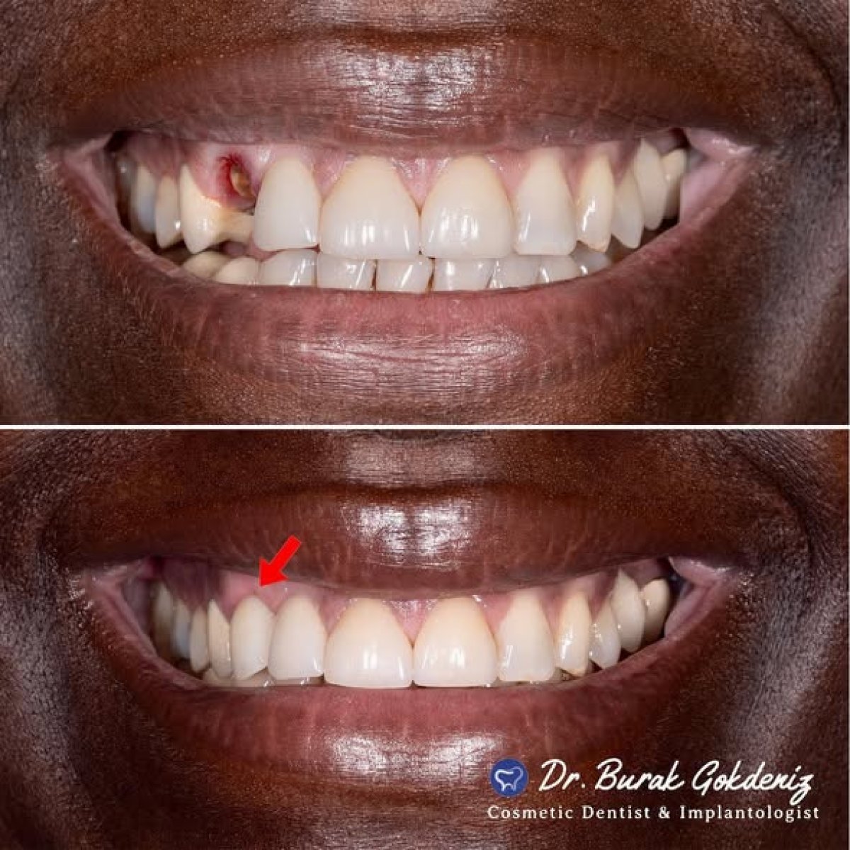 Результат до и после установки импланта с коронкой в DENTAFLY DENTAL IMPLANT & SMILE STUDIO