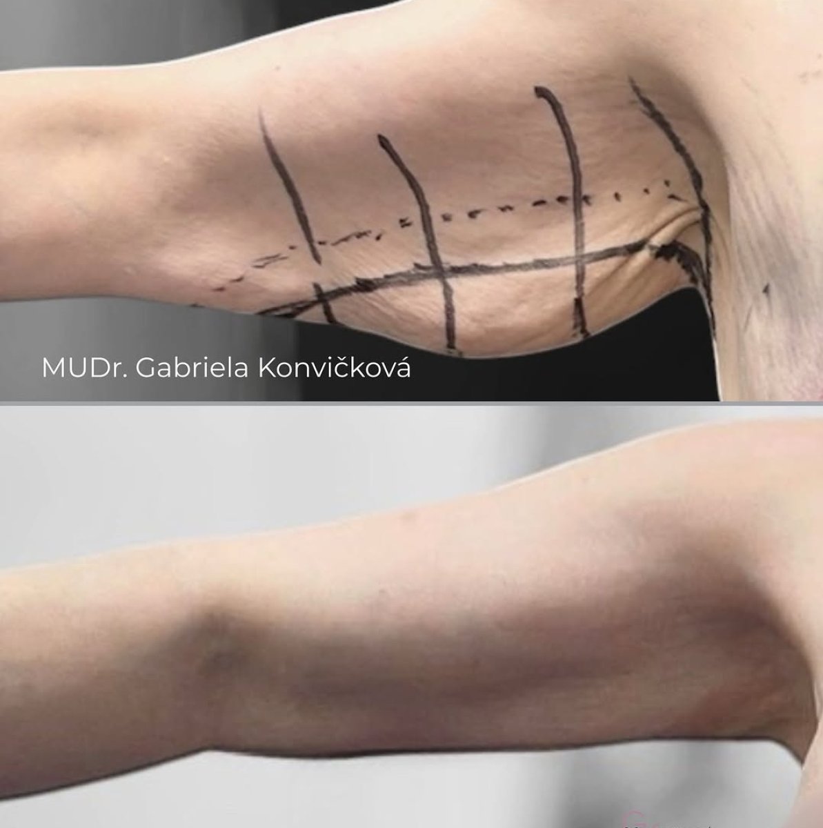 Before and after arm lift (brachioplasty) results at FORME Clinic – improved arm contour