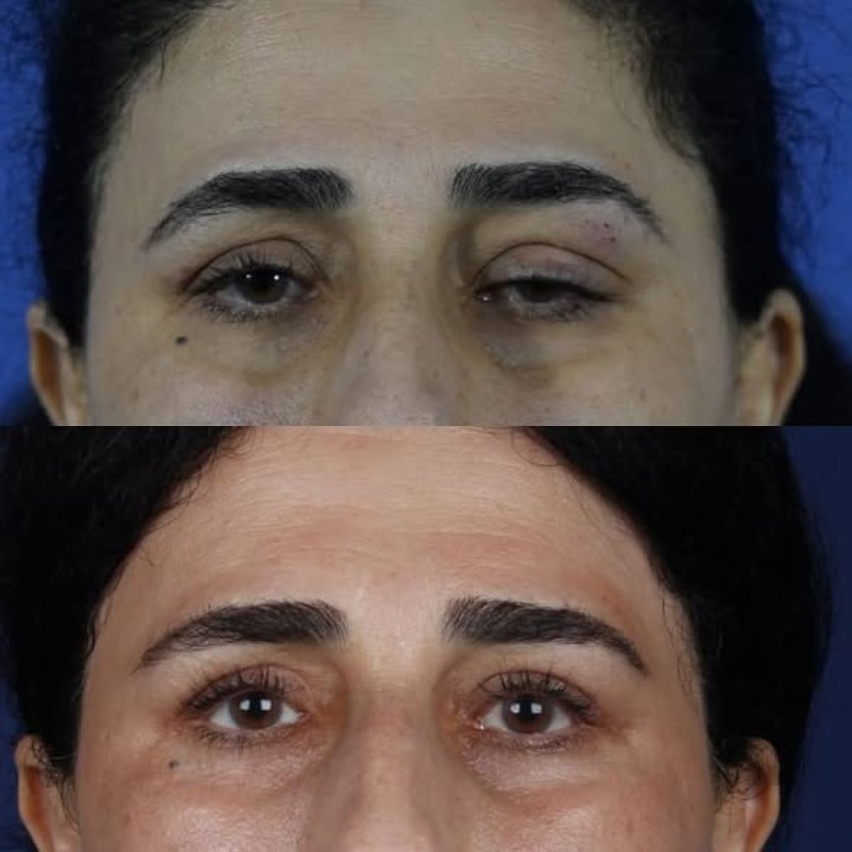 Resultados de cirugía de párpados superior e inferior antes y después en National Prime Hospital