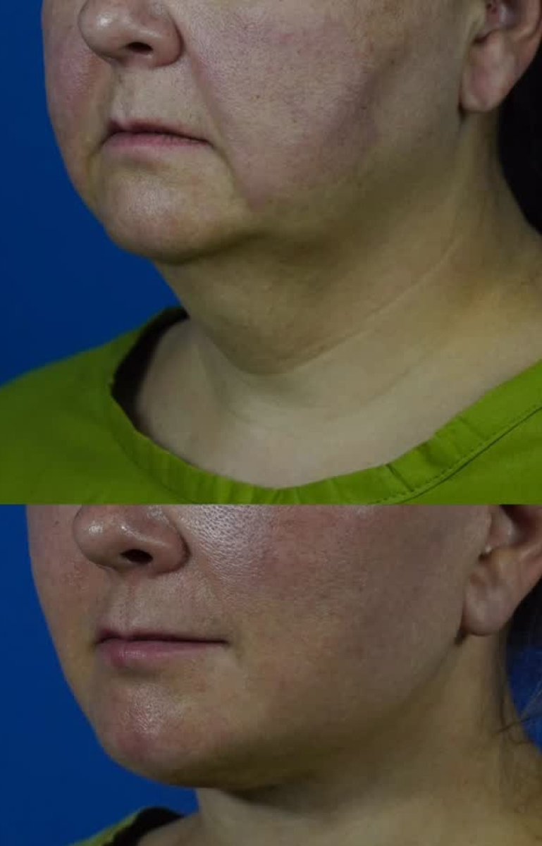 Resultados antes y después de lifting de cuello en National Prime Hospital, contorno visible