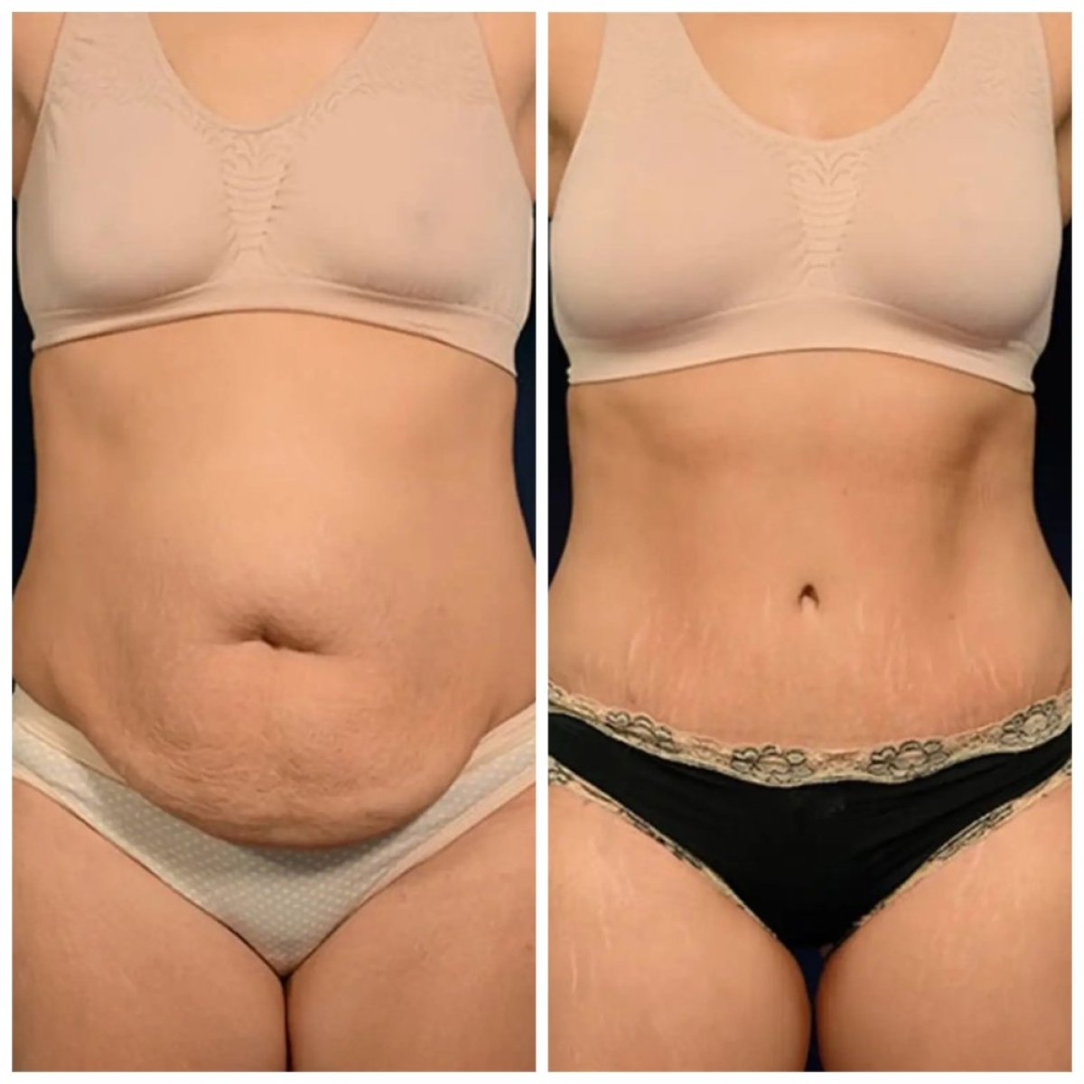 Before and after tummy tuck results at Estemoon – visible abdominal contour improvement