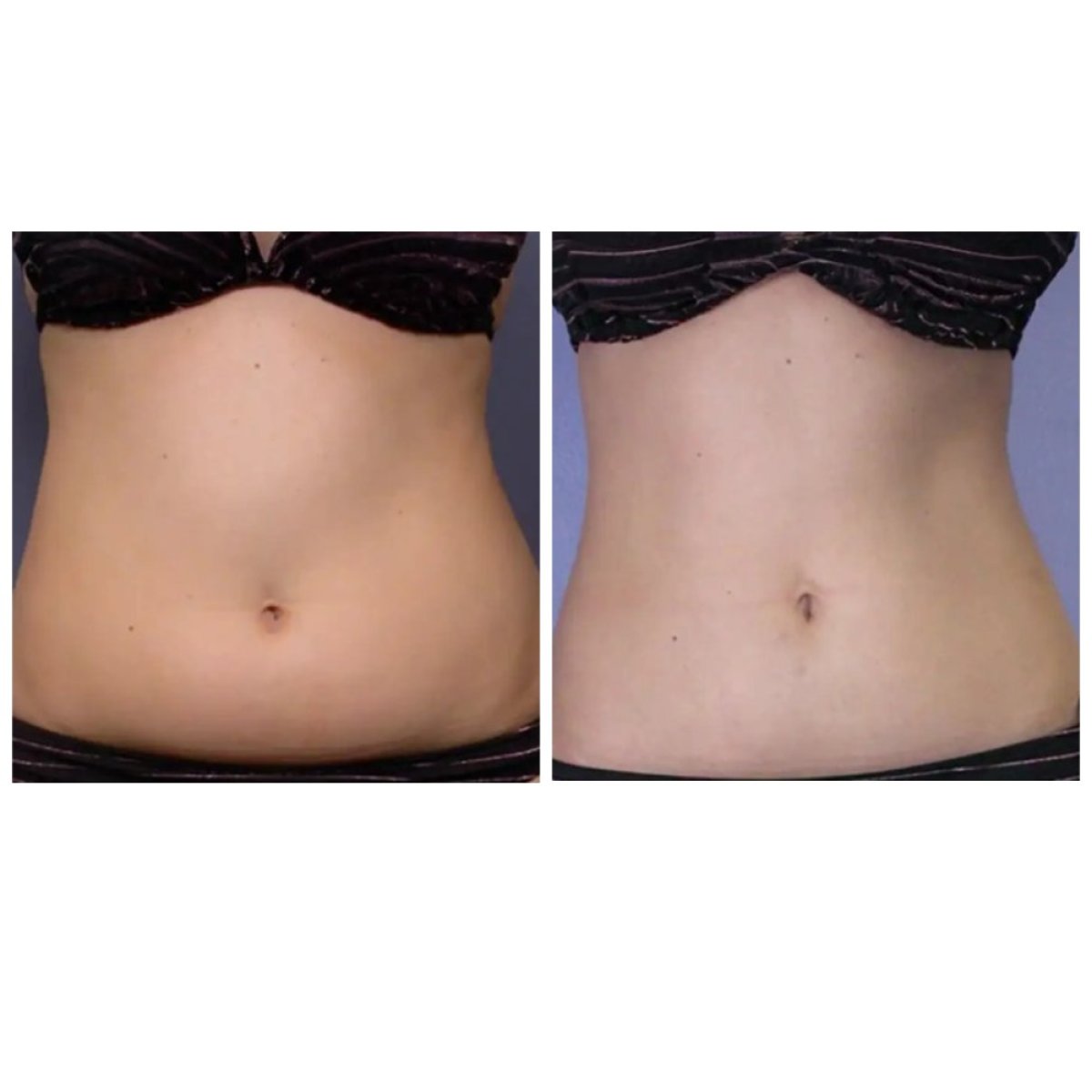 Before and after tummy tuck results at Estemoon – visible abdominal contour improvement