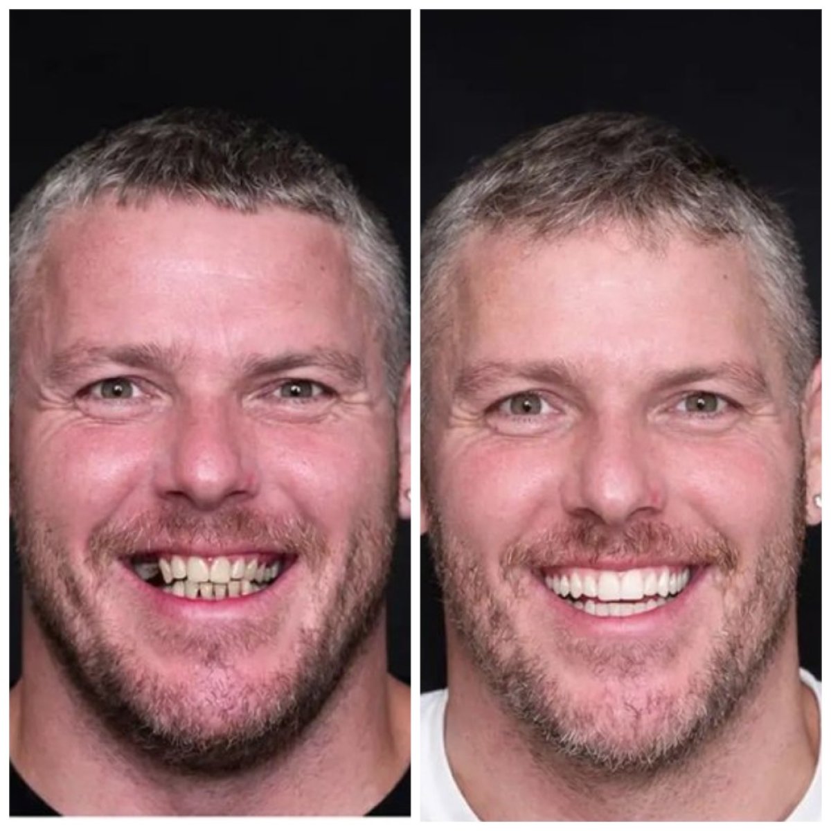 Resultados antes y después de implantes dentales en Estemoon: sonrisa restaurada