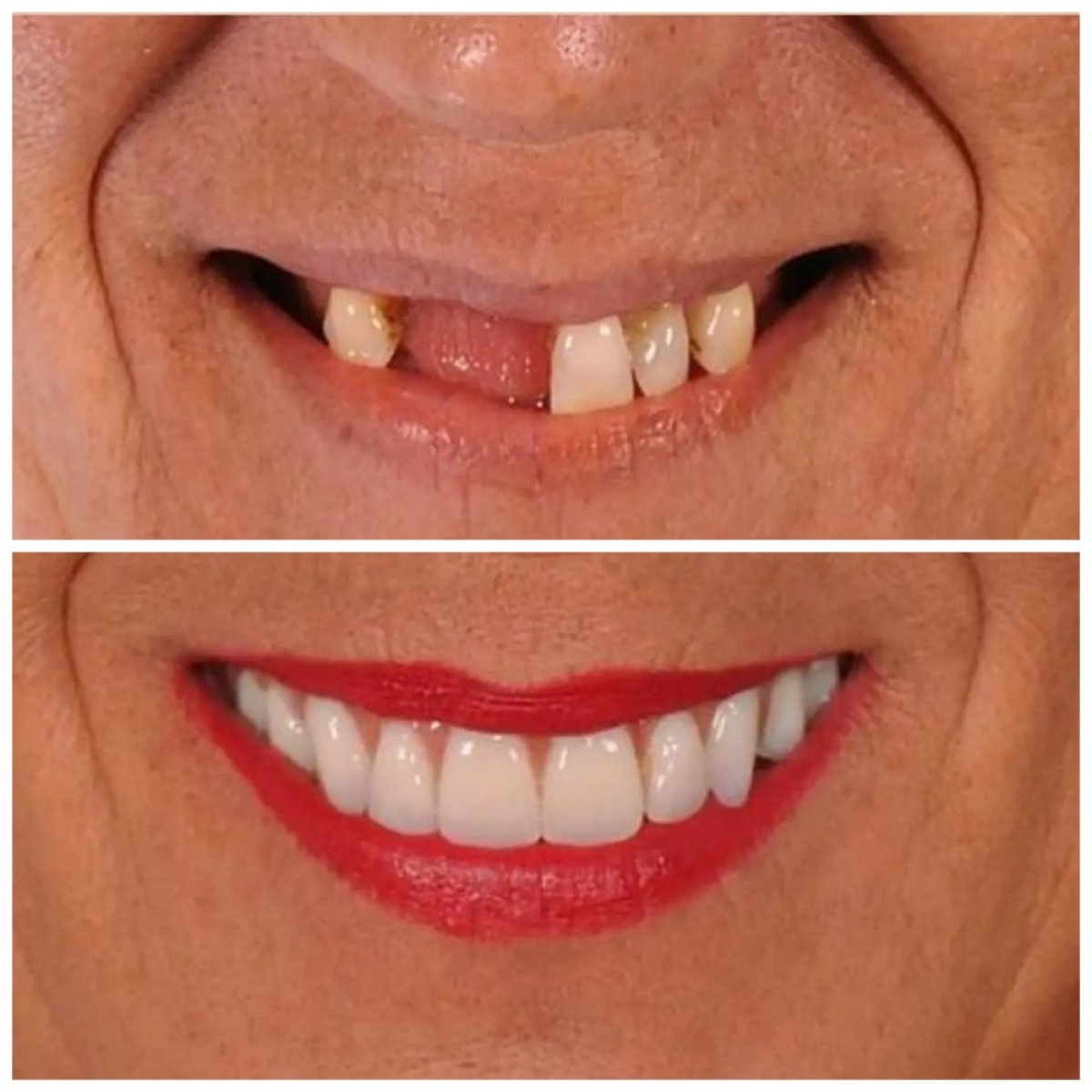 Vorher-nachher Veneers bei Estemoon – natürliches Lächel-Makeover Ergebnis