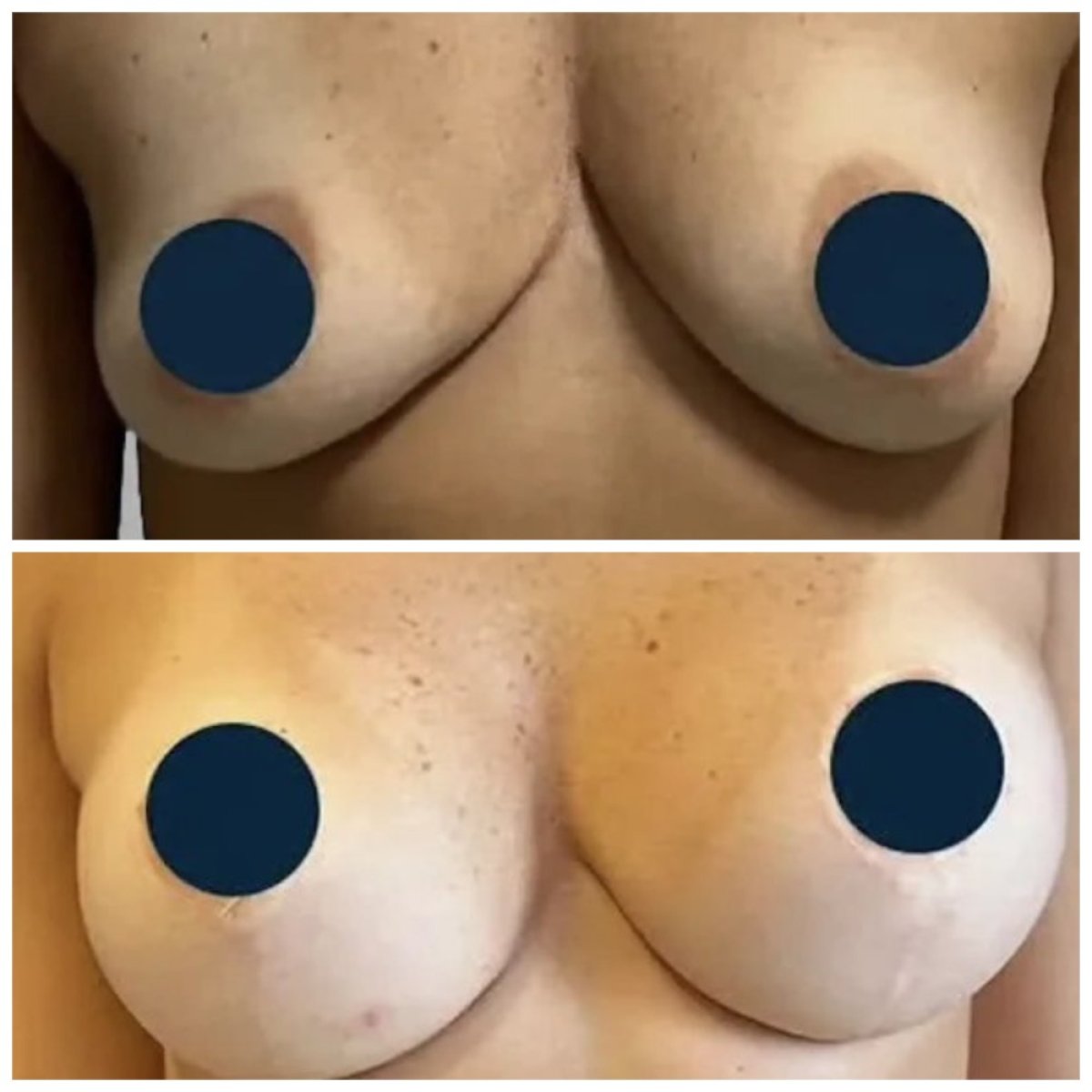 Before and after breast lift results at Estemoon – improved breast shape and contour