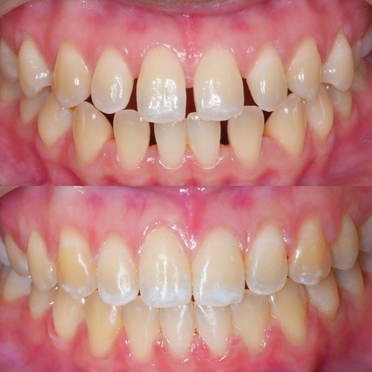 Before and after braces treatment at Stellar Dental – teeth alignment and smile improvement result